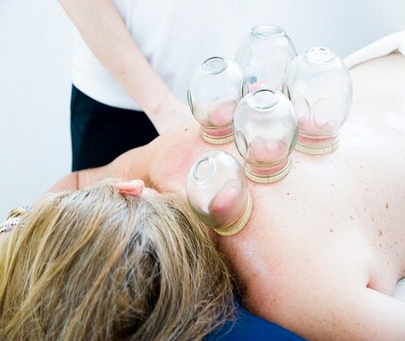 cupping-therapy-6604217_640(1)